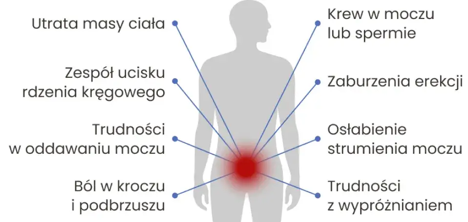Zdjęcie Jakie są objawy nowotworu prostaty? Ważne sygnały, których nie można zignorować