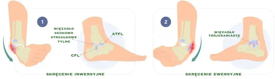Zdjęcie Co na skręcenie kostki: skuteczne metody łagodzenia bólu i leczenia