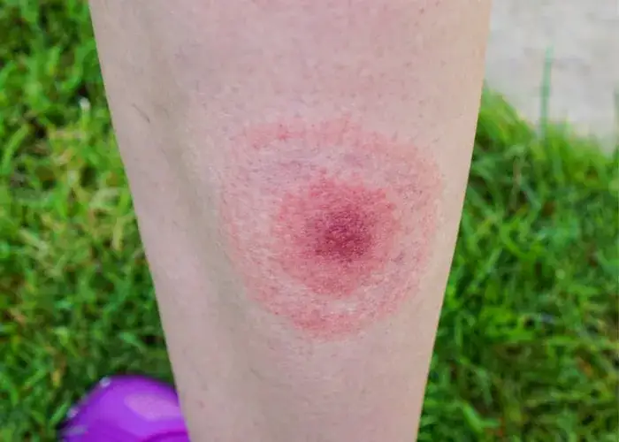 Zdjęcie Jak wygląda rumień po kleszczu? Objawy, zdjęcia i ważne informacje