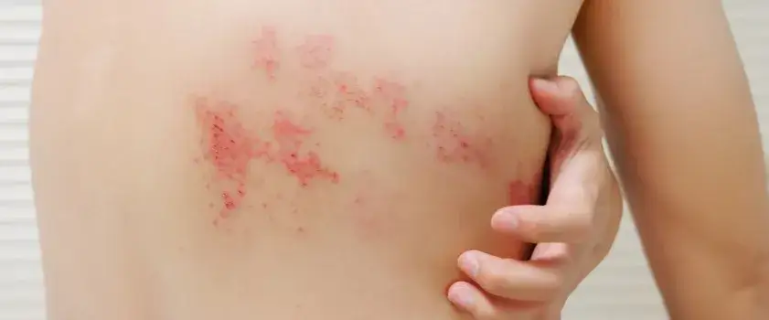 Zdjęcie Jakie leki przeciwbólowe na półpasiec pomogą złagodzić ból?