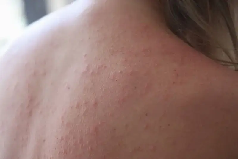 Zdjęcie Alergia na słońce objawy: Zobacz, jak rozpoznać niebezpieczne reakcje