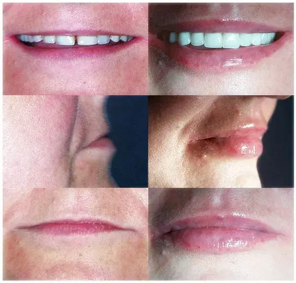 Zdjęcie Jak długo utrzymuje się efekt powiększania ust kwasem hialuronowym?