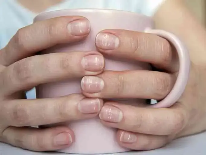 Zdjęcie Uszkodzoną macierz paznokcia czy odrośnie? Sprawdź szanse na regenerację