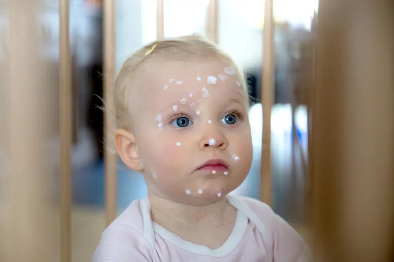Zdjęcie Ospa u niemowlaka – kiedy konieczna jest wizyta w szpitalu i jak reagować
