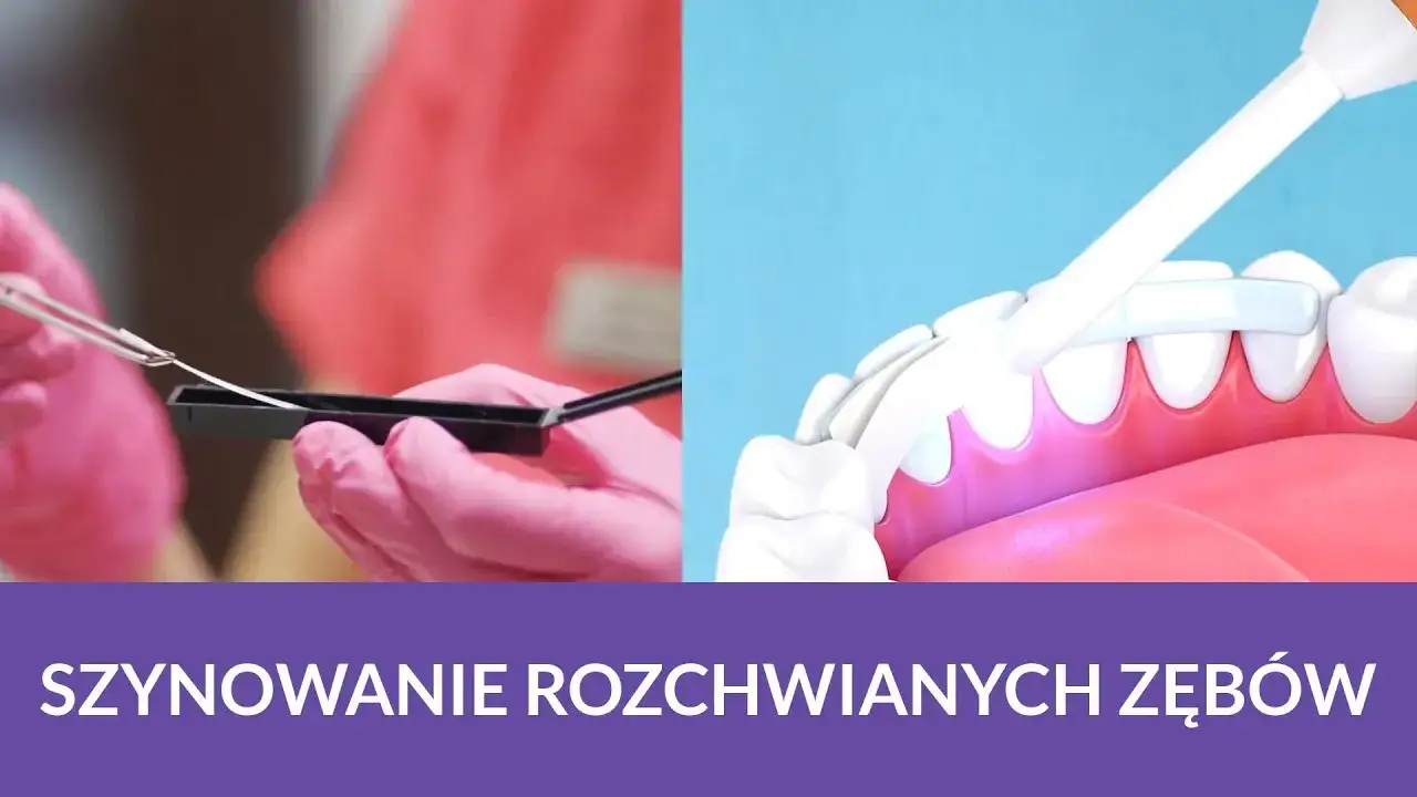 Zdjęcie Jak wzmocnić ruszające się zęby? Uratuj je! Poradnik eksperta