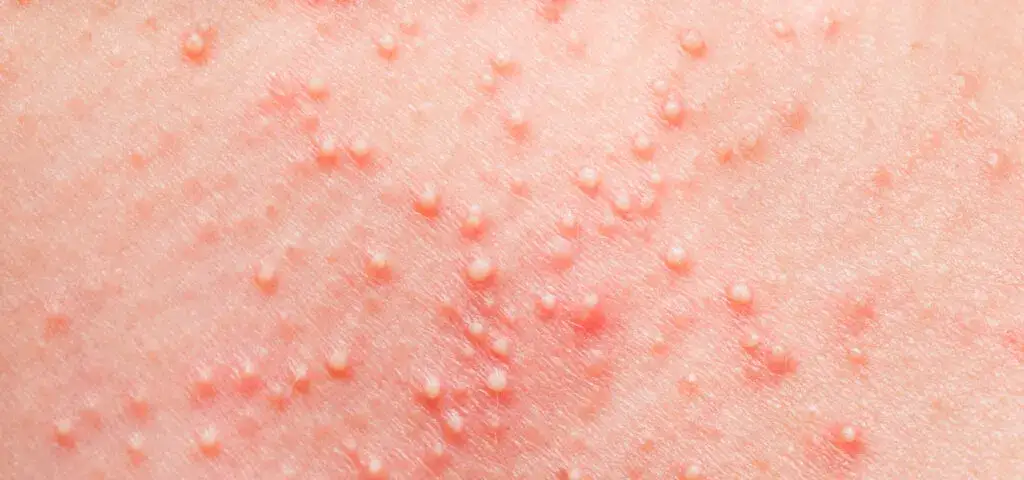 Zdjęcie Alergia na sierść objawy skórne – jak rozpoznać i leczyć dolegliwości