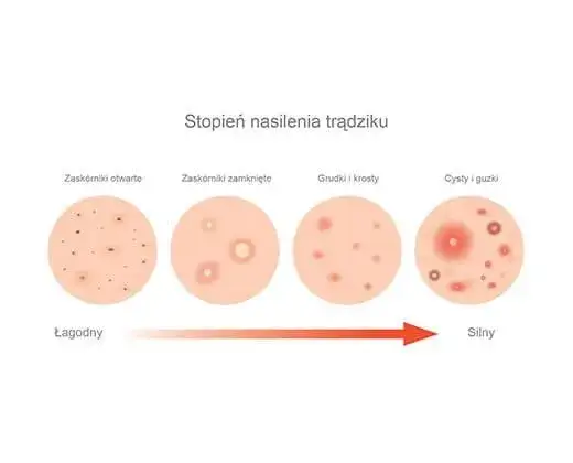 Zdjęcie Co powoduje pryszcze na twarzy? Odkryj przyczyny i rozwiązania