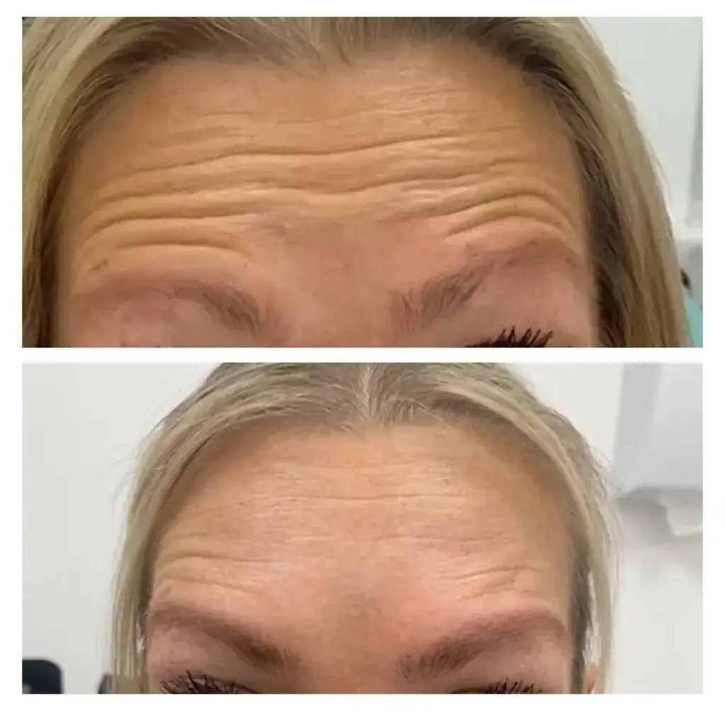 Zdjęcie Jak przeliczyć jednostki Azzalure na Botox dla skutecznych efektów