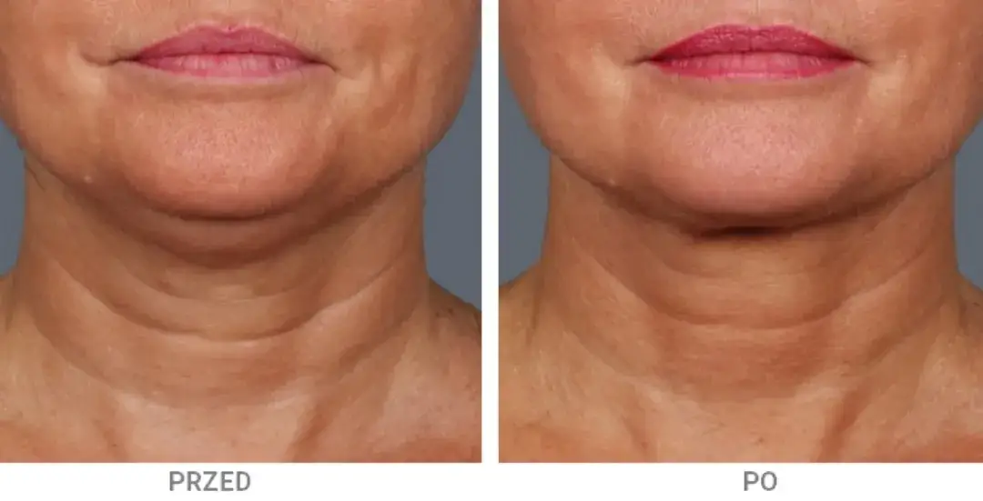 Zdjęcie Skutki uboczne lipolizy: jak unikać poważnych zagrożeń i objawów