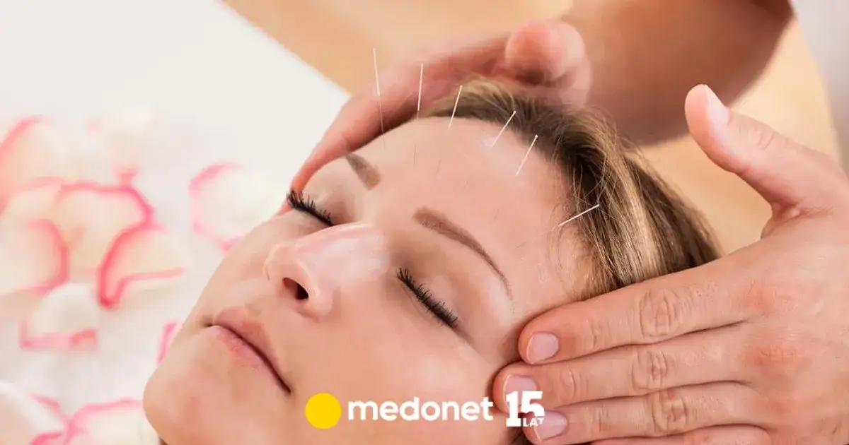 Zdjęcie Akupunktura co to - zrozumienie tej starożytnej metody leczenia
