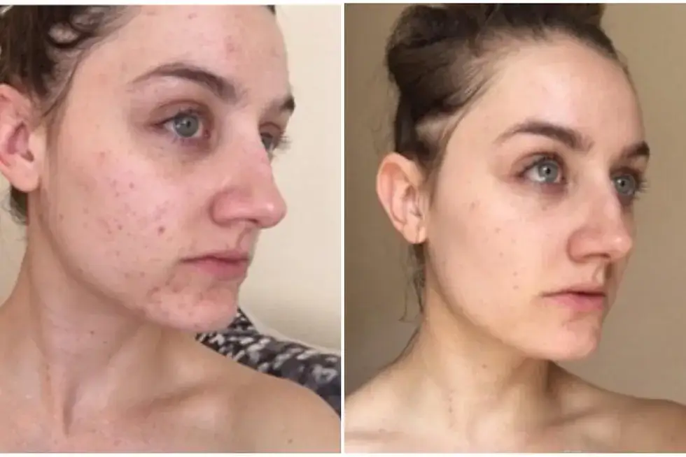 Zdjęcie Płyn micelarny czy zmywać? Odkryj, co może zaszkodzić skórze