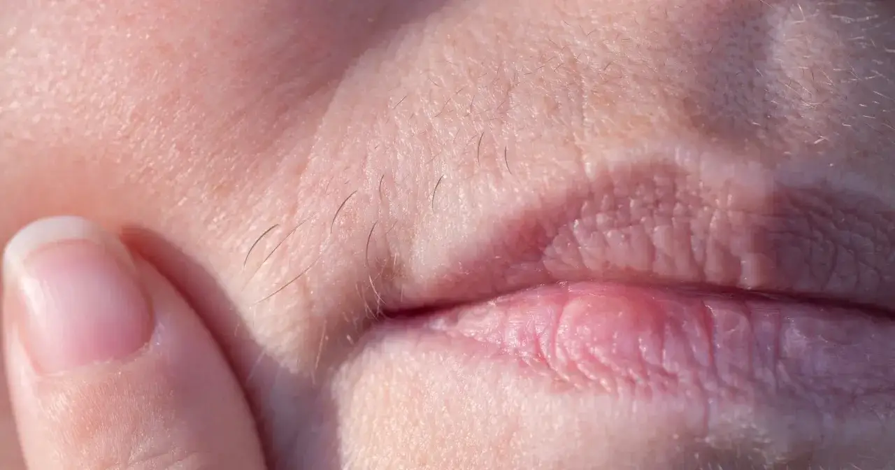 Zdjęcie Ile kosztuje depilacja laserowa wąsika? Ceny i porównanie ofert