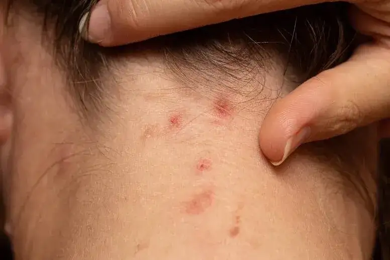 Zdjęcie Dlaczego pryszcze bolą? Poznaj przyczyny i skuteczne rozwiązania