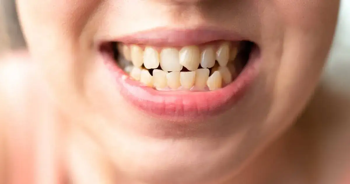 Zdjęcie Co jeśli śnią się zęby? Odkryj ich głębokie znaczenie i emocje