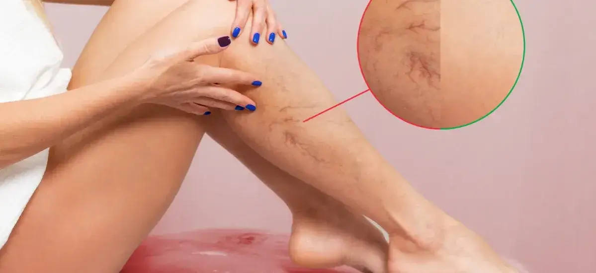 Zdjęcie Jak oczyścić żyły z cholesterolu i poprawić zdrowie serca