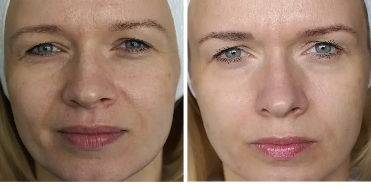 Zdjęcie Laser frakcyjny kiedy makijaż - uniknij podrażnień i błędów