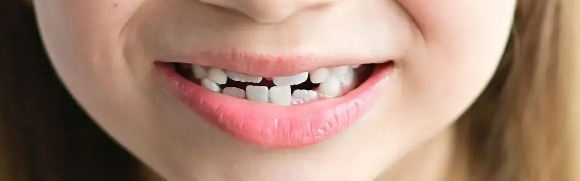 Zdjęcie Jak leczyć krzywy zgryz od smoczka i uniknąć dalszych problemów