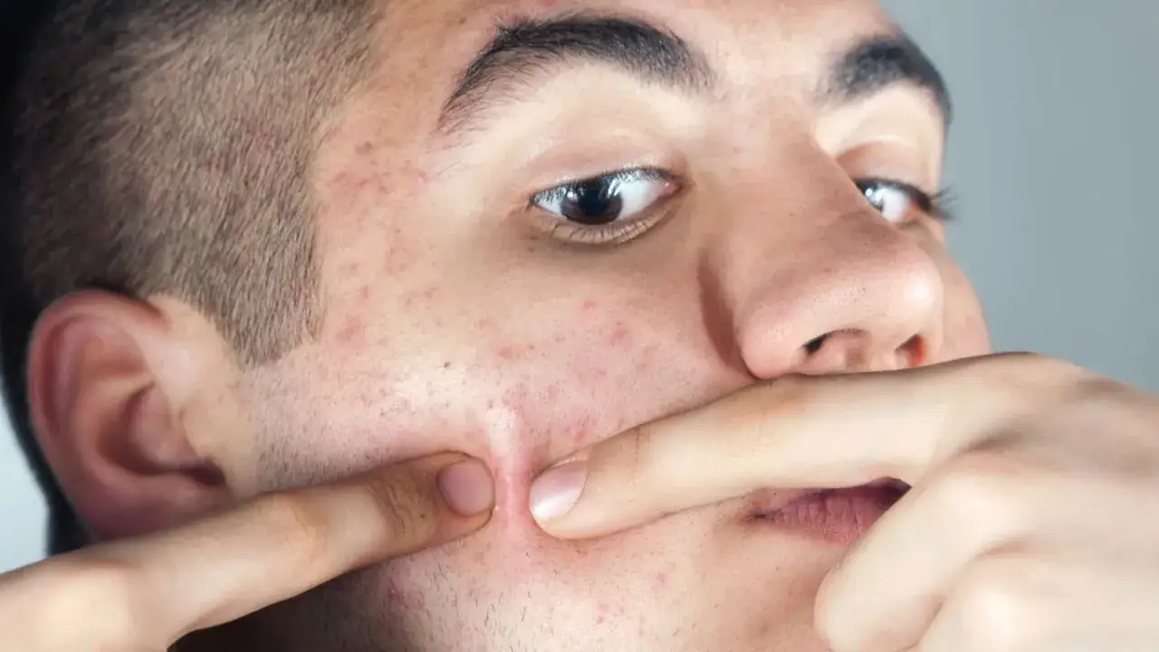 Pryszcze: Co naprawdę działa? Od domowych sposobów po dermatologa