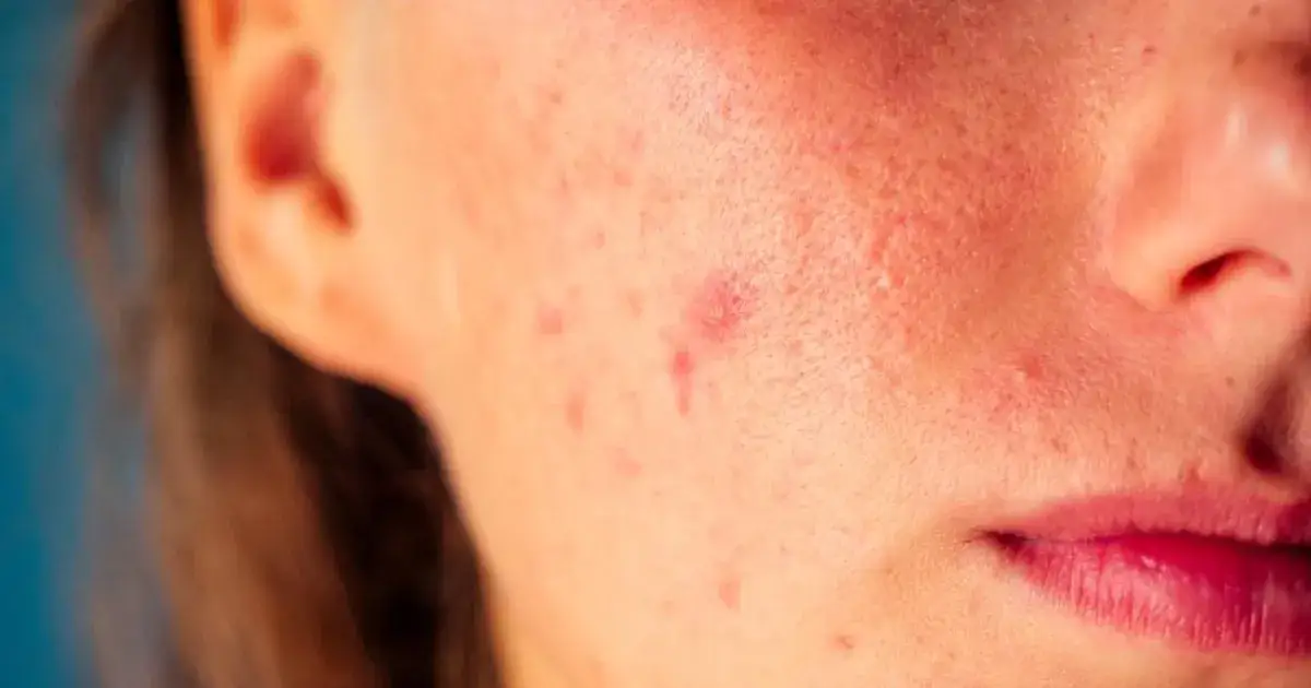 Pryszcz który nie znika: co oznacza i kiedy iść do dermatologa