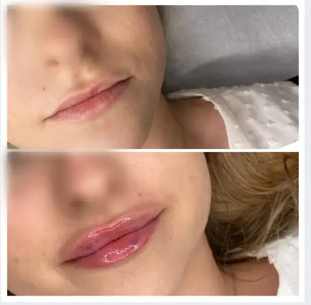 Gdzie najlepiej powiększyć usta w Krakowie? Opinie i ceny klinik