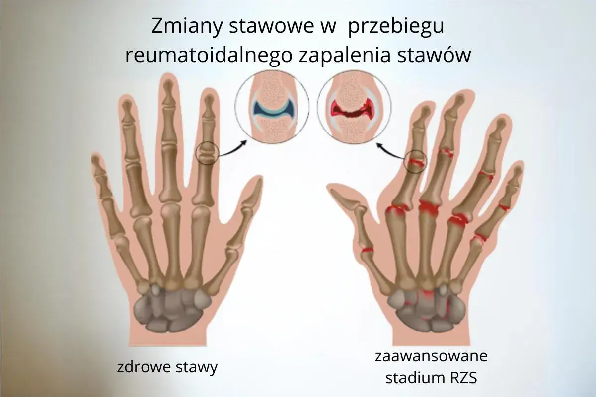 Reumatoidalne zapalenie stawów u dzieci objawy, które mogą zaskoczyć rodziców