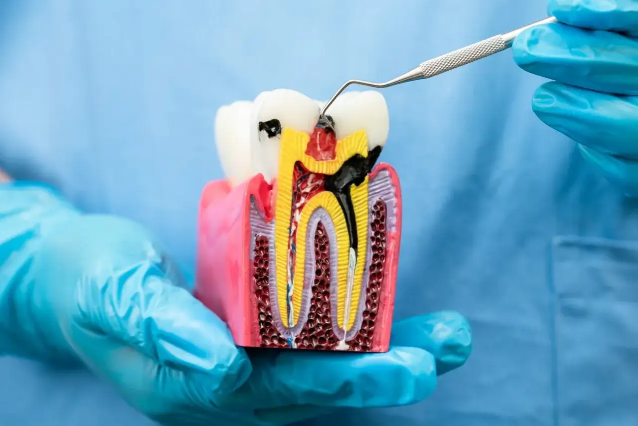 Ząb 4 górny: Ile kanałów? Klucz do skutecznego leczenia kanałowego.
