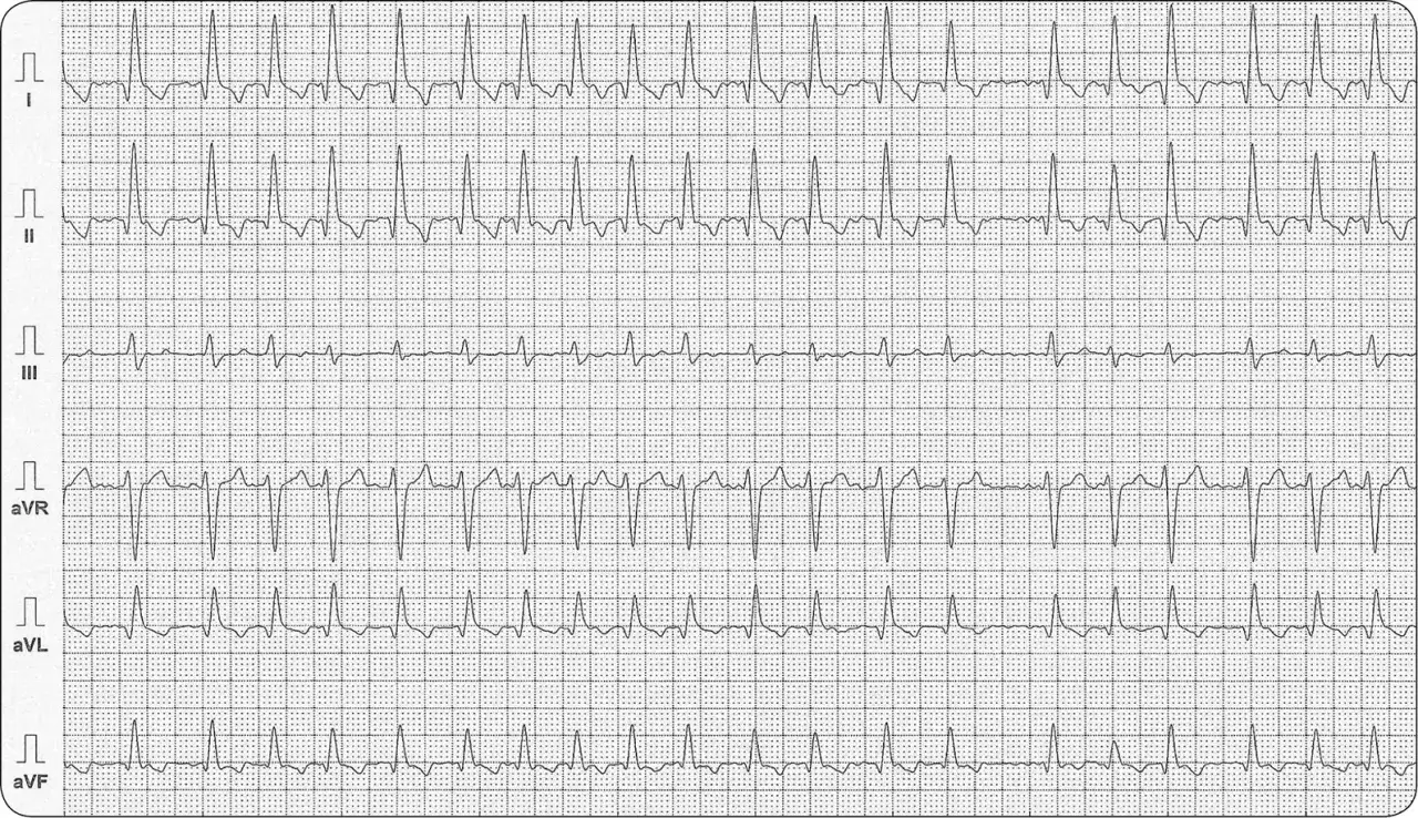 Jakie leki na migotanie przedsionków? Pełny przewodnik dla pacjenta