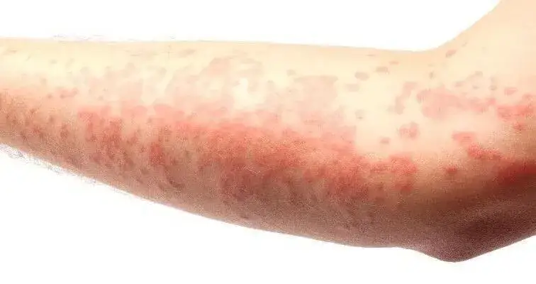 Świerzb objawy i jak wygląda na skórze – poznaj niepokojące sygnały