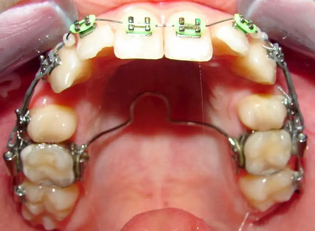 Jak bezpiecznie przekręcać aparat Hassa bez ryzyka uszkodzenia i utraty gwarancji
