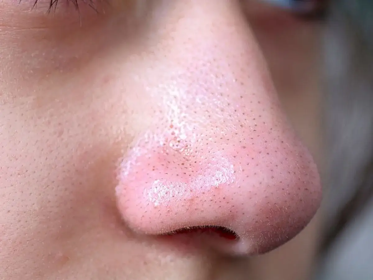 Zbliżenie na nos, gdzie widać, jak wyglądają zapchane pory – małe, ciemne punkciki na skórze.