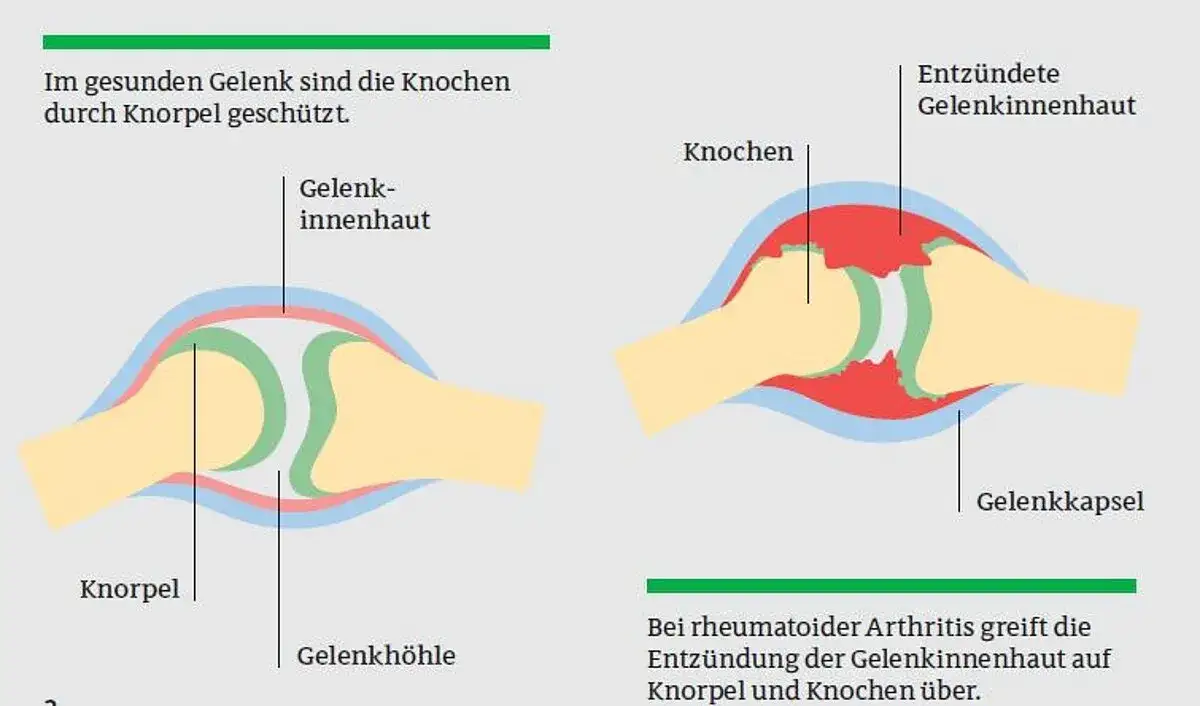 Die häufigsten Symptome der rheumatoiden Arthritis und ihre Folgen