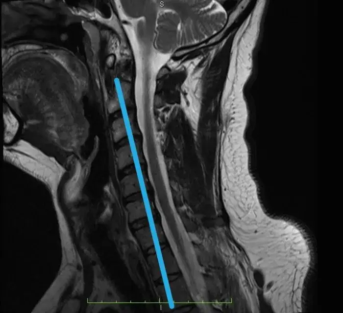 Skręcenie karku: Jak rozpoznać uraz i kiedy na SOR?