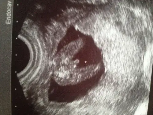 Jak rozpoznać płeć dziecka na usg - co musisz wiedzieć, by nie pomylić