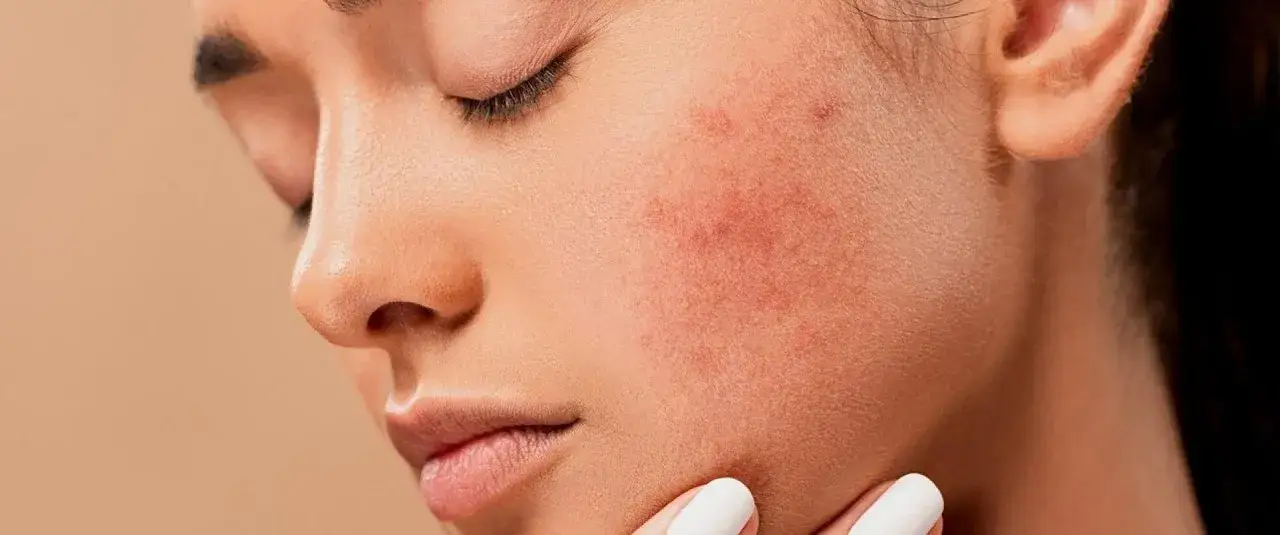 Czysta cera bez trądziku? Odkryj kompleksowy plan profilaktyki