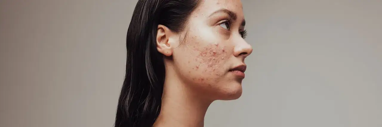 Reine Haut: Effektive Tipps gegen unreine Gesichtshaut & Pickel