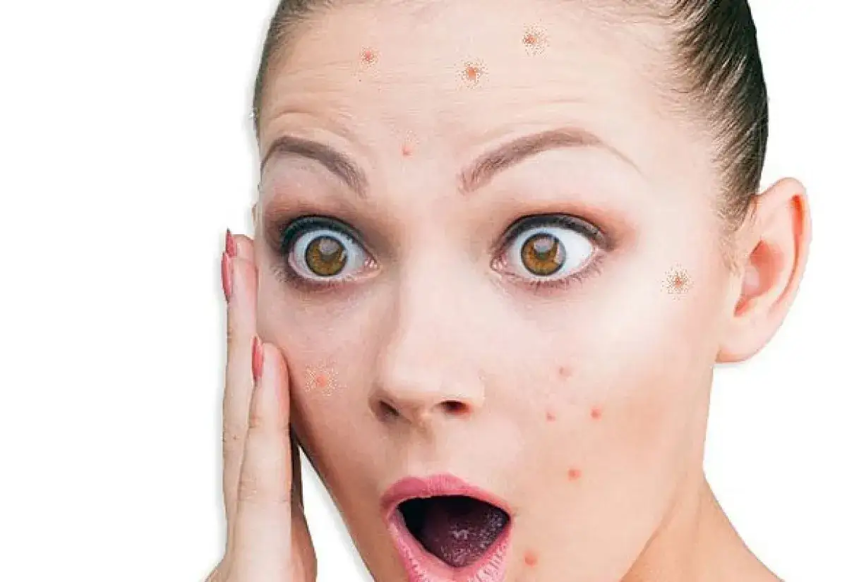 Pasta do zębów na pryszcze: Ile trzymać? Ekspert radzi inaczej!