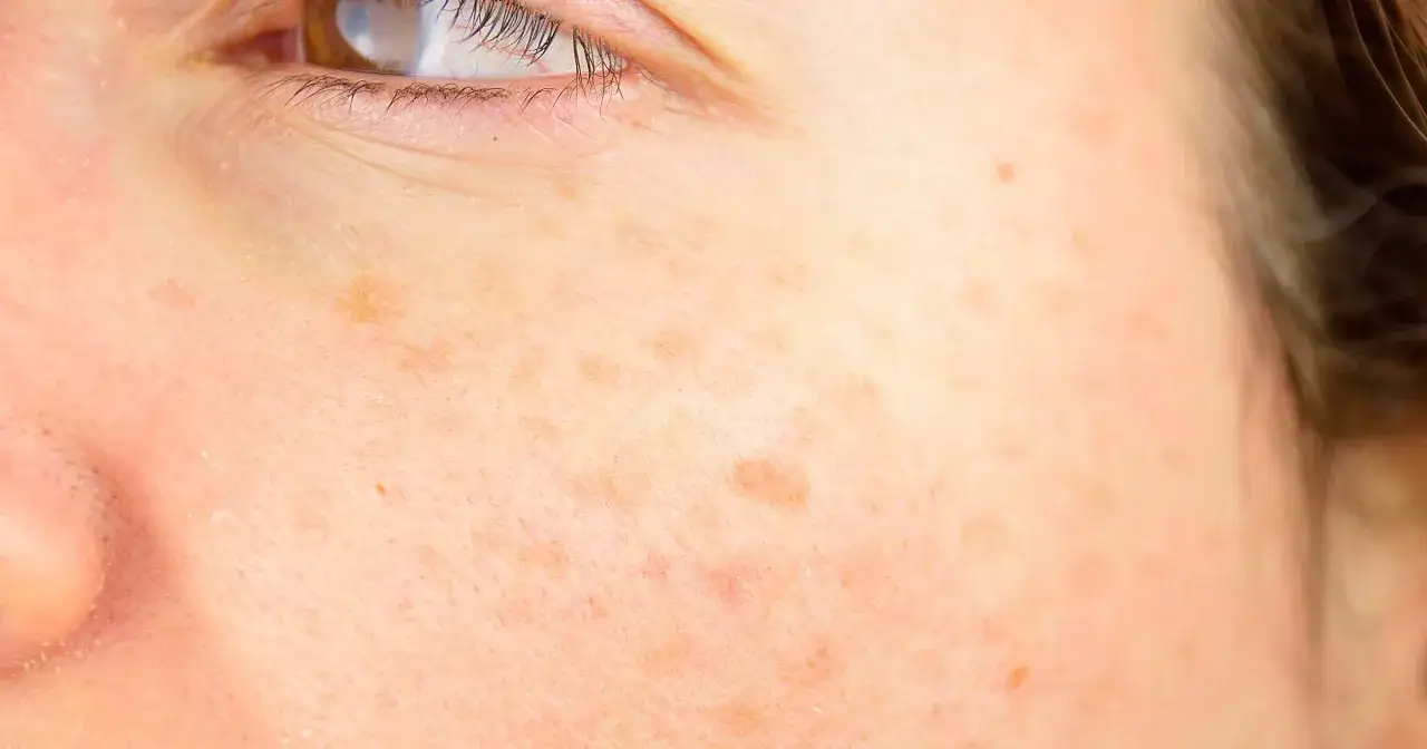 Zbliżenie na skórę z widocznymi żółtymi plamami, piegami i drobnymi niedoskonałościami.