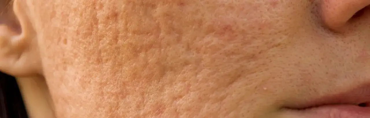 Jak skutecznie walczyć z niedoskonałościami na twarzy i poprawić cerę