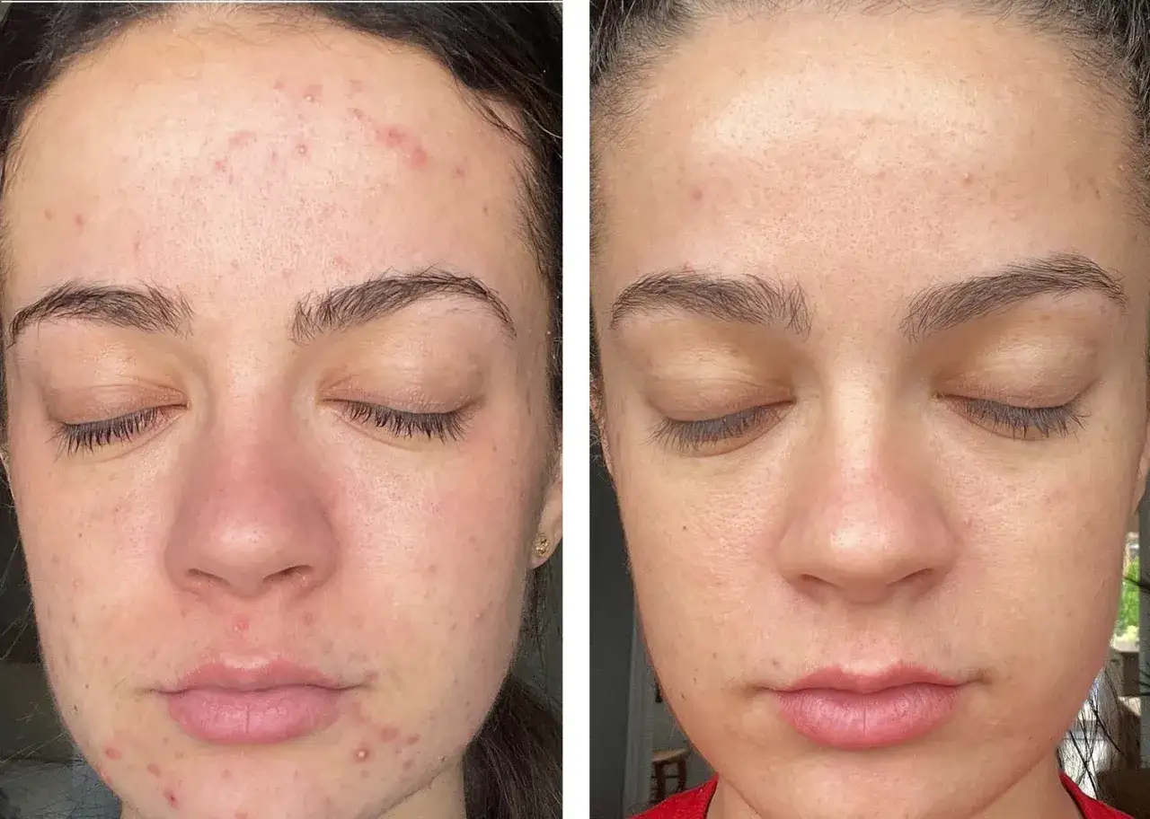 Co daje peeling enzymatyczny? Korzyści, efekty i dla kogo jest najlepszy