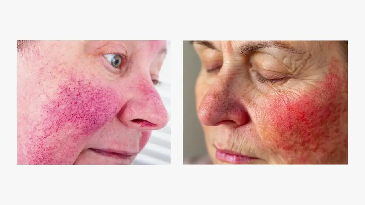 Rote Gesichtshaut Krankheit: Symptome, Ursachen und effektive Behandlungen