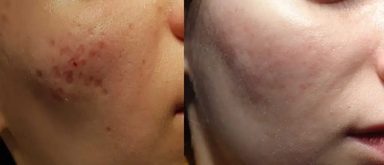 Blizny po pryszczach: Od domowych po laser. Odzyskaj gładką skórę!