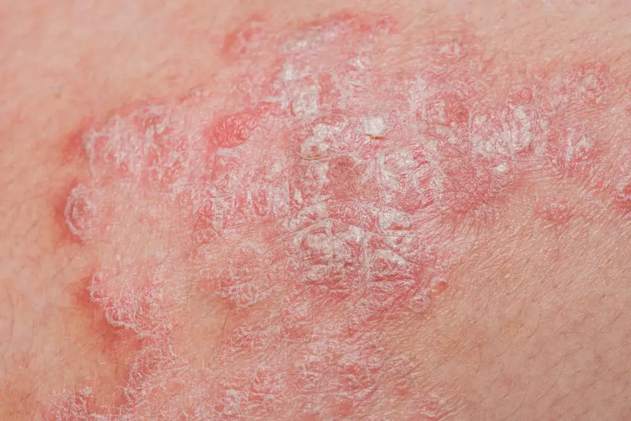 Co na łuszczycę bez recepty? Skuteczne metody łagodzenia objawów