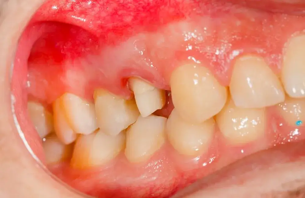 Recesja dziąseł objawy: jak rozpoznać i uniknąć bólu zębów