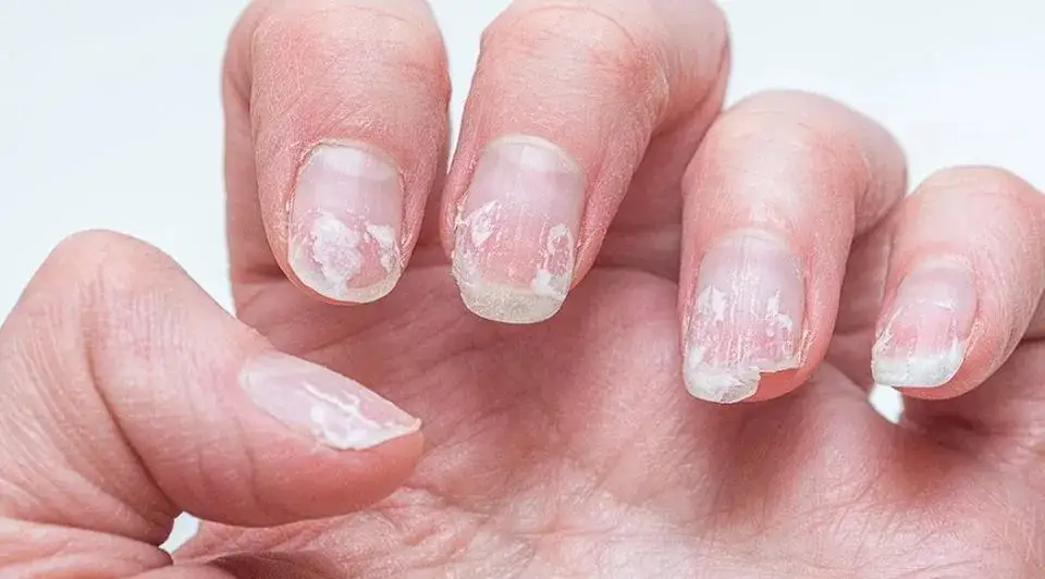 Rozdwajające się paznokcie - skuteczne sposoby na ich wzmocnienie