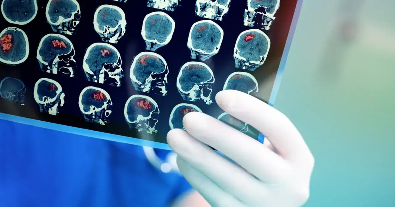 Nie ignoruj! Objawy zaburzeń krążenia mózgowego kiedy działać?