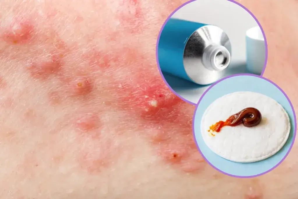 Ile trzymać maść ichtiolową na pryszczu, aby uniknąć bólu?