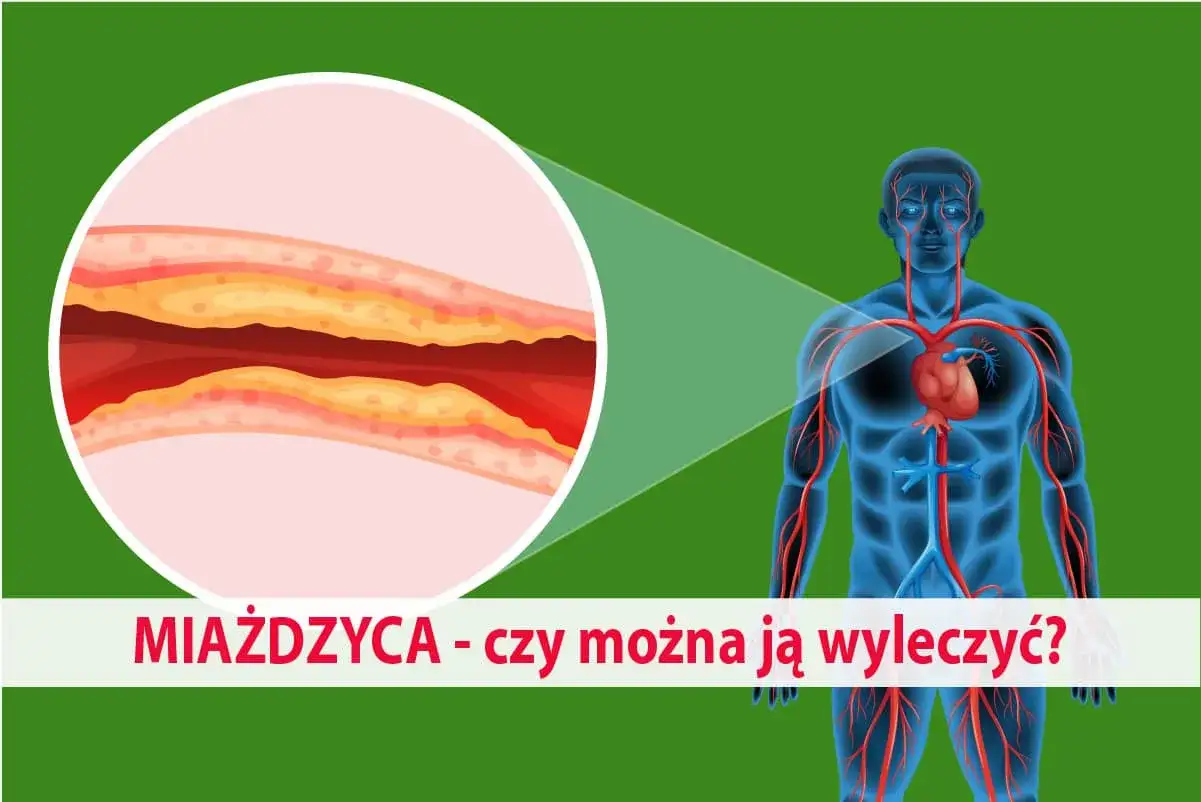 Ilustracja przedstawia ludzkie ciało z widocznym układem krążenia i powiększony przekrój tętnicy z miażdżycą. Jakie badania na miażdżycę są kluczowe?