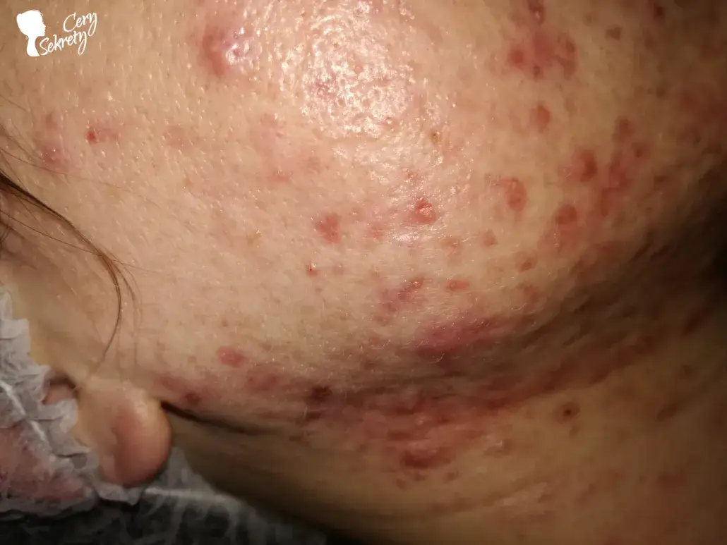 Blizny po pryszczach: Jak skutecznie się ich pozbyć? Poradnik eksperta