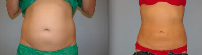 Czy liposukcja laserowa jest skuteczna? Efekty i ryzyko zabiegu