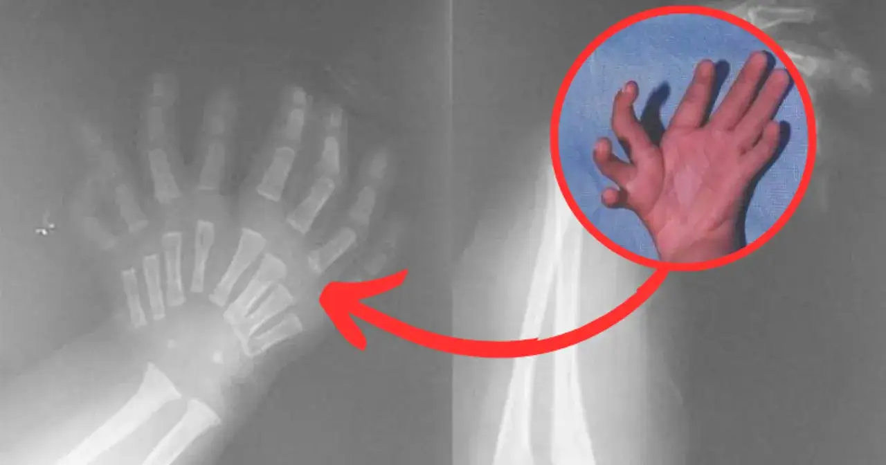 Syndrom obcej ręki: Czy to możliwe, że ręka działa sama? Poznaj prawdę